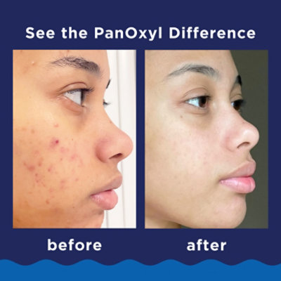 Panoxyl 10% Acne Foaming Wash - 5.5 Oz. - Image 3