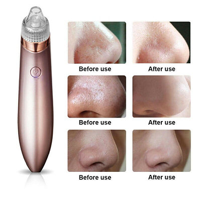 Smilegive - Blackhead Vacuum Pore Cleaner - Image 1